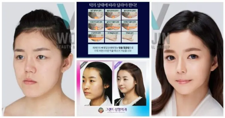 Тонове нарязани кости – страна, в която не можеш да оцелееш без пластична операция на лицето!