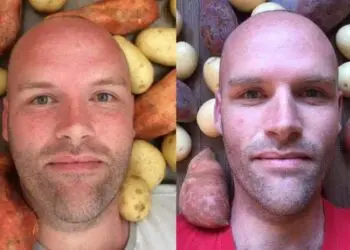Мъжът, който отслабна за една година, хапвайки само картофи, сподели какво е станало след това