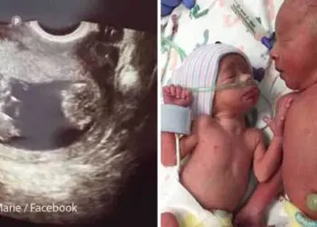 Лекарите нямали никаква надежда за единия от близнаците ѝ, но тя не се отказала от него! Ето ги след 2.5 години!