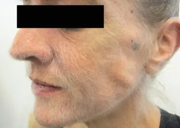 Лекарите са открили причината, поради която лицето на жената прекомерно окосмя