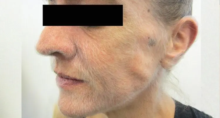 Лекарите са открили причината, поради която лицето на жената прекомерно окосмя