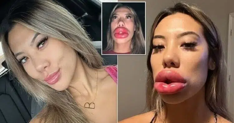 24 годишна жена реши да направи корекция на устните си и се озова в болница