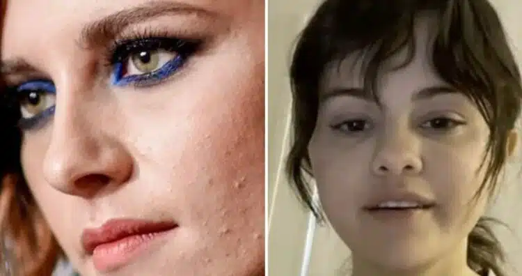 Торбички под очите и акне: как наистина изглежда кожата на знаменитостите без обработки