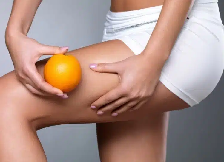 За да нямаш целулит – НЕ консумирай тези храни!