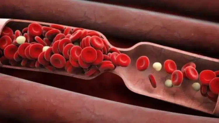 Ето начин за намаляване на риска от образуване на кръвни съсиреци
